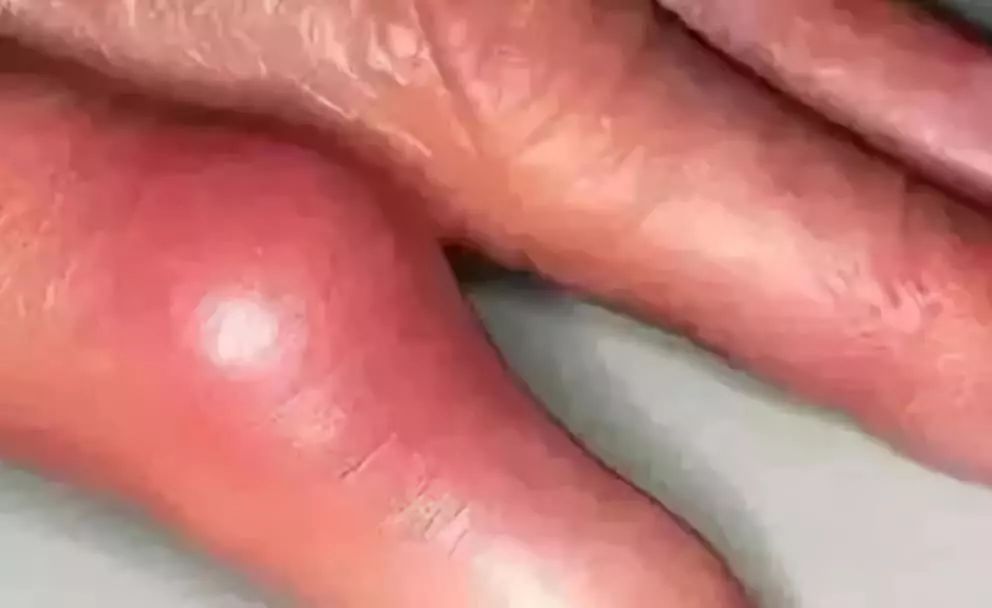 最全食物嘌呤表远离痛风你要会吃,各种豆类嘌呤的含量表鹰嘴豆