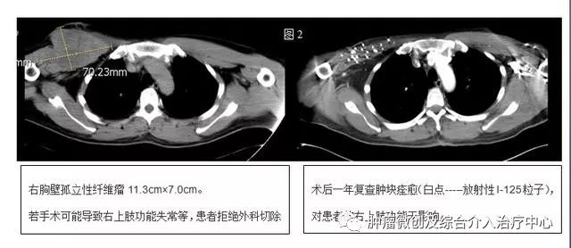 碘125粒子植入术适合哪类肿瘤,碘125粒子植入治癌