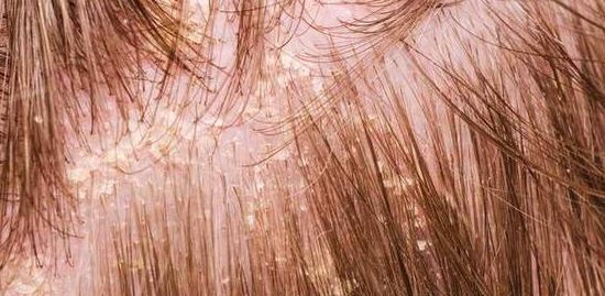 头上头皮屑和剪发虫怎么解决,头皮屑多和肚子里有虫有关系吗