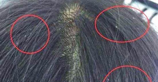 头上头皮屑和剪发虫怎么解决,头皮屑多和肚子里有虫有关系吗