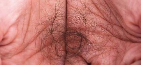 头上头皮屑和剪发虫怎么解决,头皮屑多和肚子里有虫有关系吗