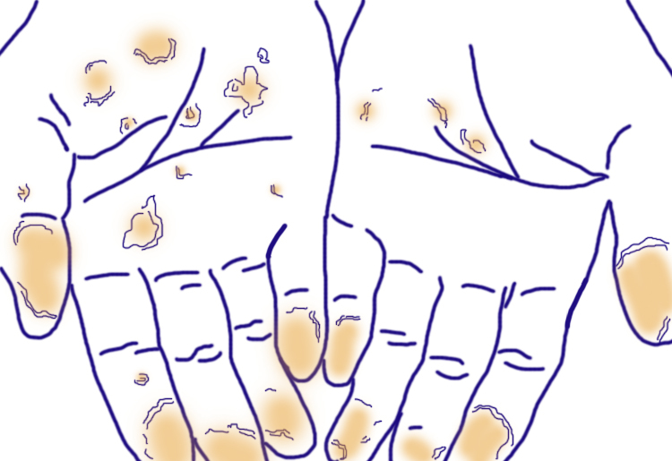 为什么手脱皮以后指纹用不了,一招治愈季节性手脱皮