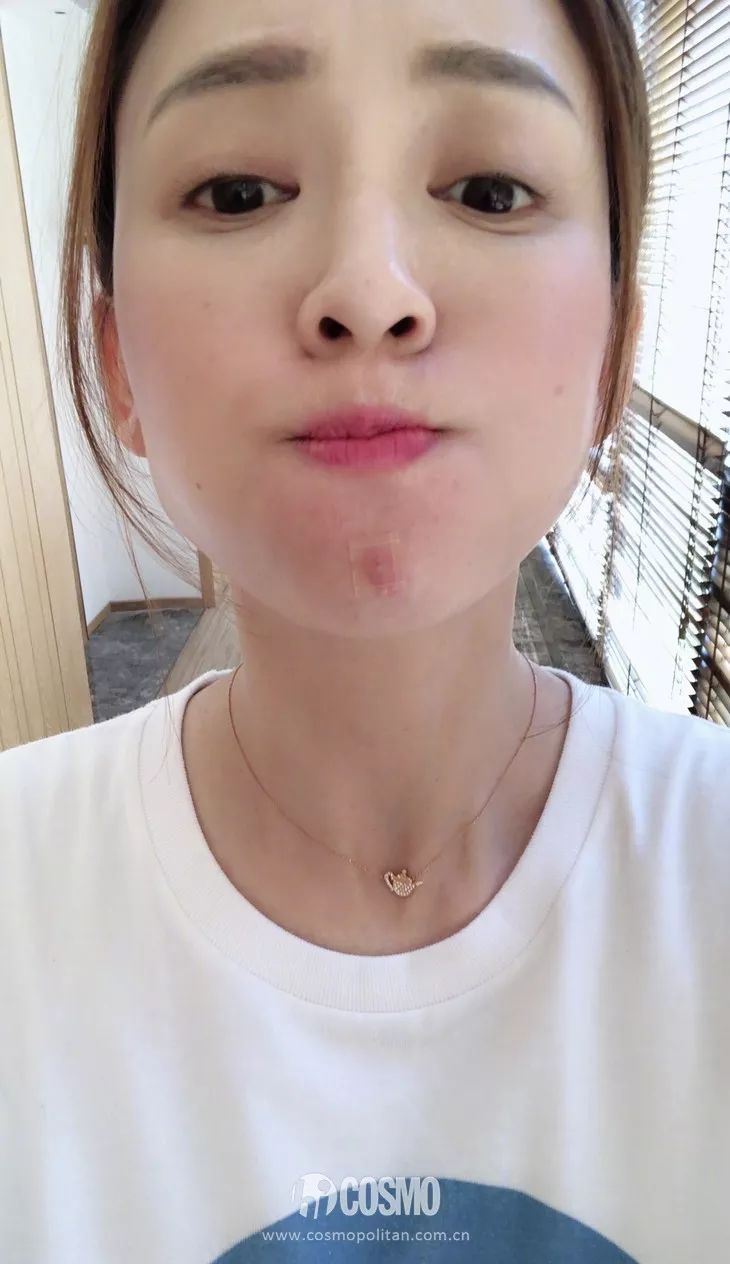 沈梦辰用痔疮膏治痘,痔疮膏真的能止血吗