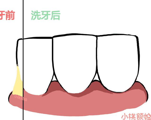 洗牙的真相,洗牙的全过程究竟是怎样的呢