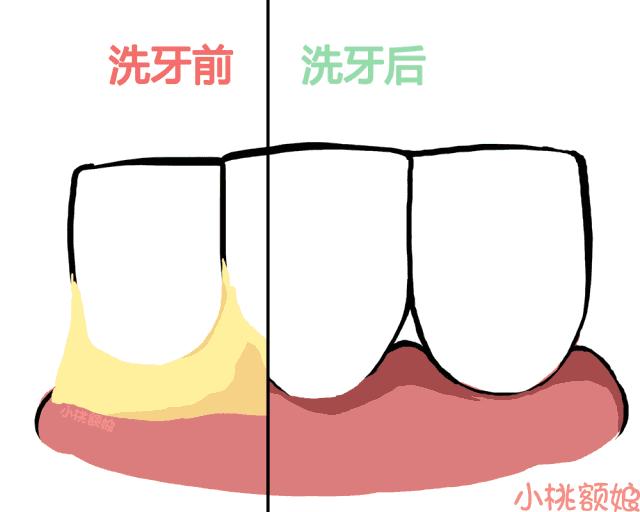 洗牙的真相,洗牙的全过程究竟是怎样的呢