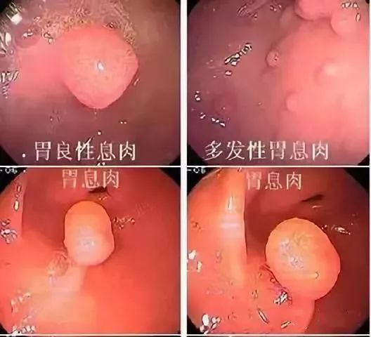 一文盘点｜临床上常见的息肉病