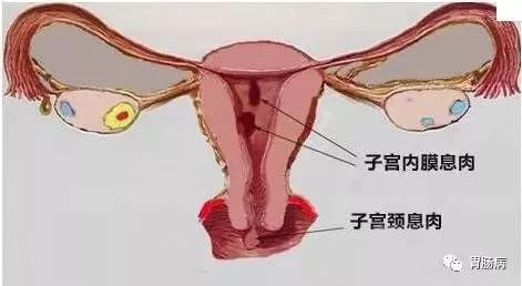 一文盘点｜临床上常见的息肉病
