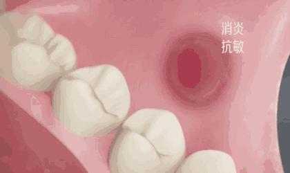 快速清除口臭去除牙渍,牙黄口臭三分钟见效