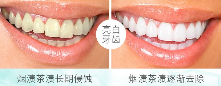 快速清除口臭去除牙渍,牙黄口臭三分钟见效
