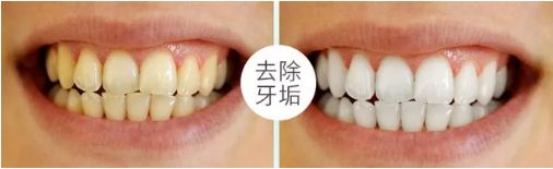 快速清除口臭去除牙渍,牙黄口臭三分钟见效