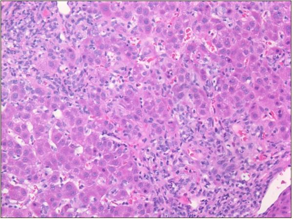 米诺环素引起的肝损害怎么办,药物诱发自身免疫性肝炎