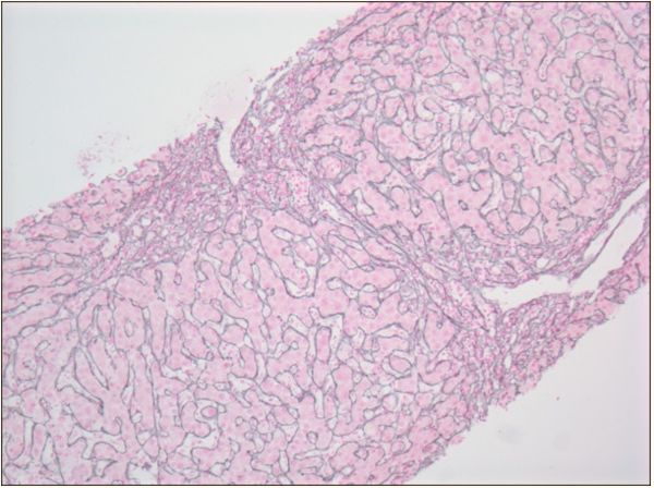 米诺环素引起的肝损害怎么办,药物诱发自身免疫性肝炎