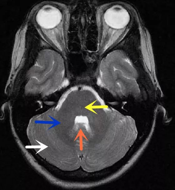 影像病例学习(3):后颅窝实性占位病变