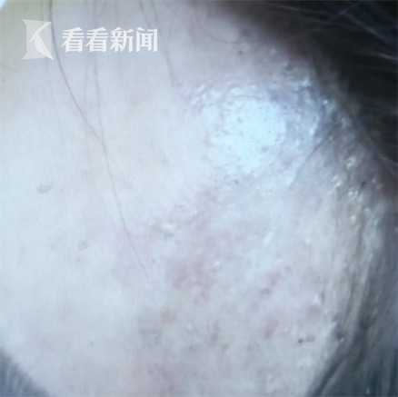 爱美之心需谨慎,注射玻尿酸脸部呈现老态怎么办