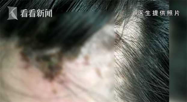 爱美之心需谨慎,注射玻尿酸脸部呈现老态怎么办