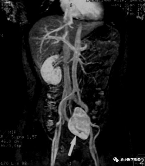 临床常见6种肾脏变异，鉴别诊断要点一览