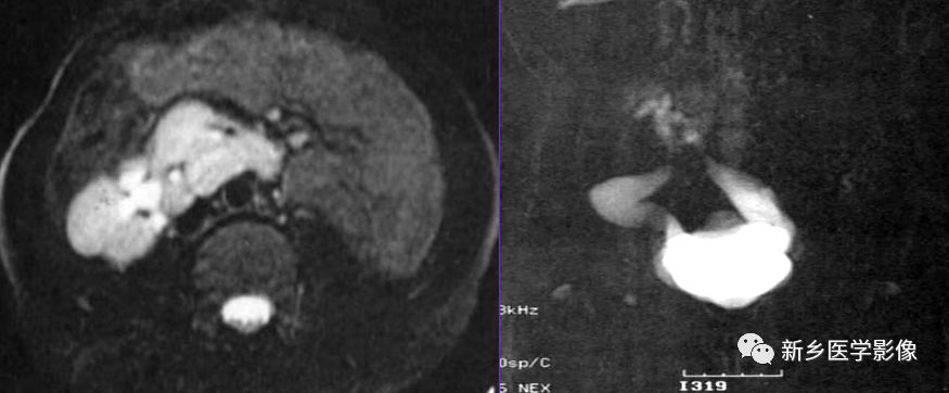 临床常见6种肾脏变异，鉴别诊断要点一览