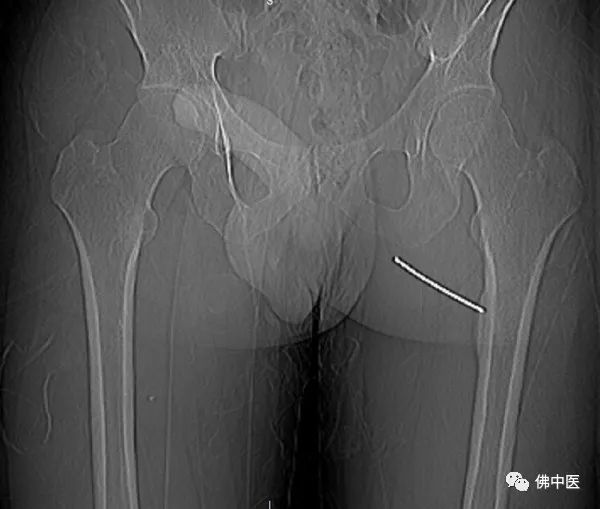 「安心过年」微创手术直击病灶！两骨瘤患者慕名而来，携健康回家