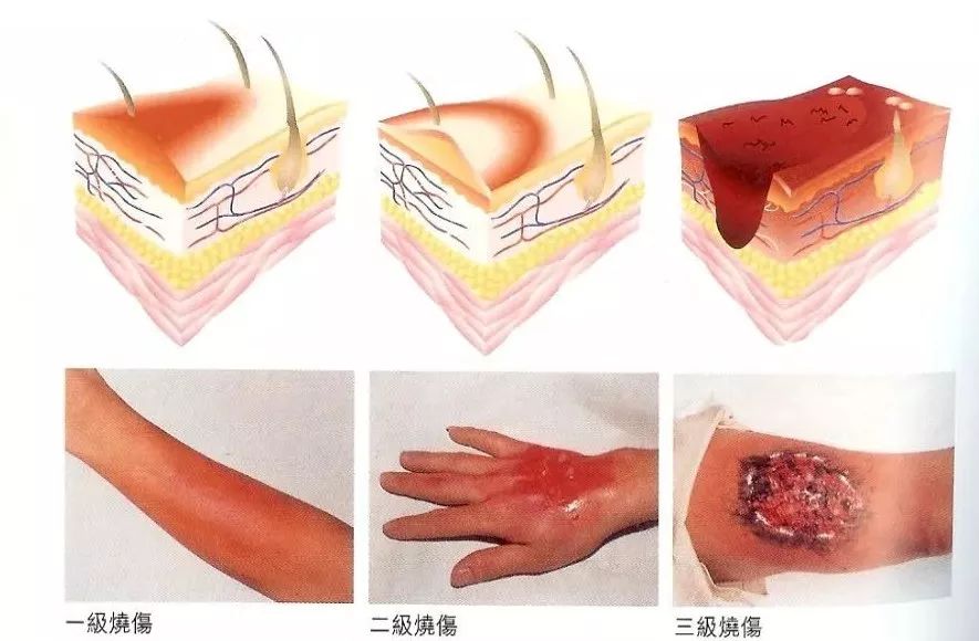 春节时如果被爆竹炸伤该如何急救,过年放鞭炮炸伤怎么处理