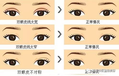 石杭燕双眼皮失败案例,双眼皮手术最失败视频