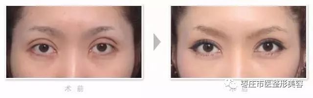 石杭燕双眼皮失败案例,双眼皮手术最失败视频