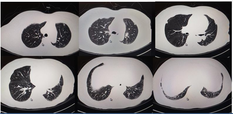50岁女性胸腔积液是怎么形成的呢,26岁胸腔积液引起原因