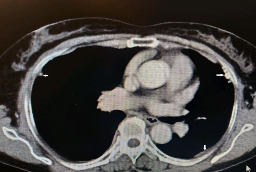 50岁女性胸腔积液是怎么形成的呢,26岁胸腔积液引起原因
