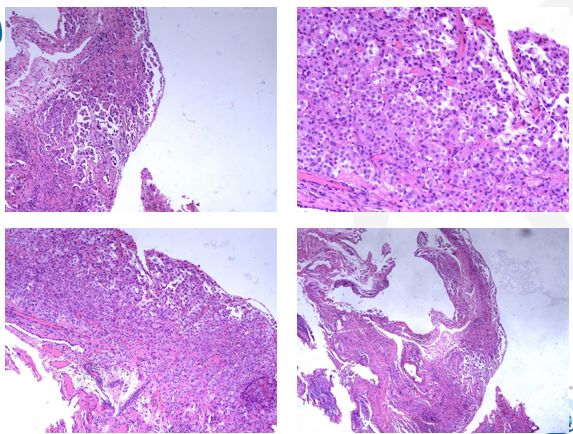 50岁女性胸腔积液是怎么形成的呢,26岁胸腔积液引起原因