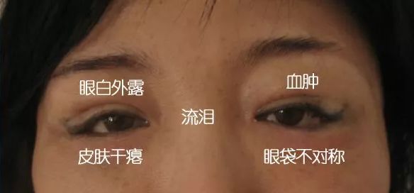 眼袋黑眼圈细纹抹一抹,去眼袋黑眼圈涂抹方法