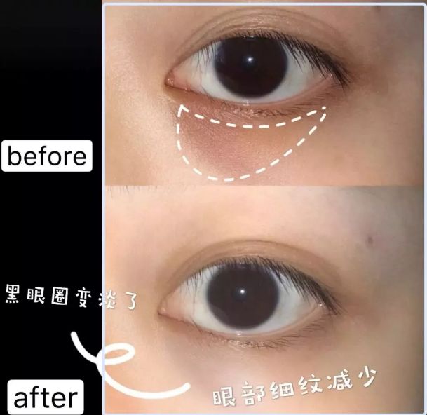 眼袋黑眼圈细纹抹一抹,去眼袋黑眼圈涂抹方法