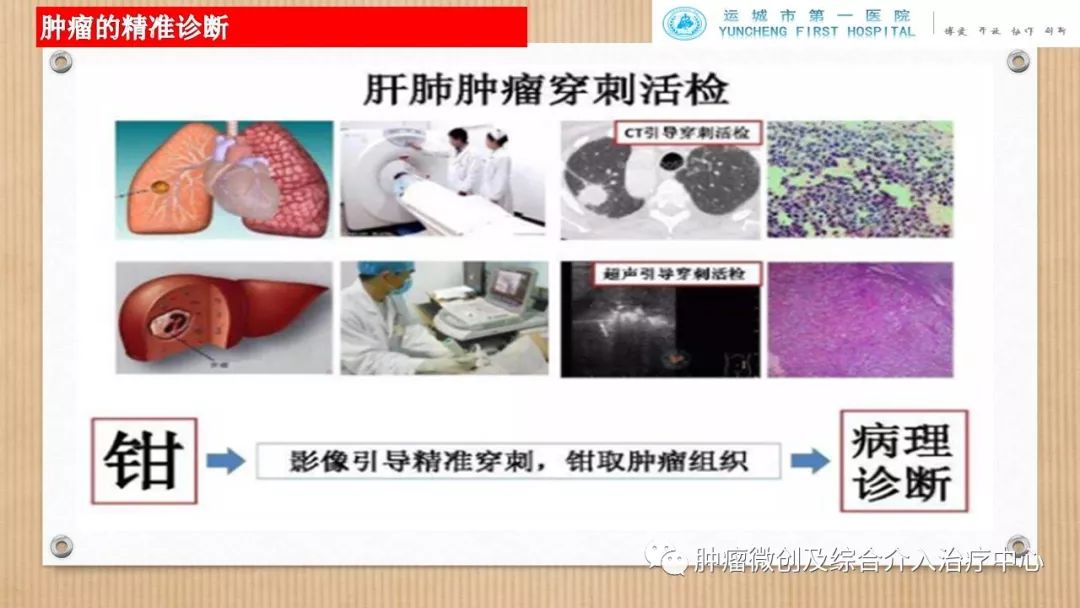 脾动脉栓塞术,脾栓塞手术的适应症