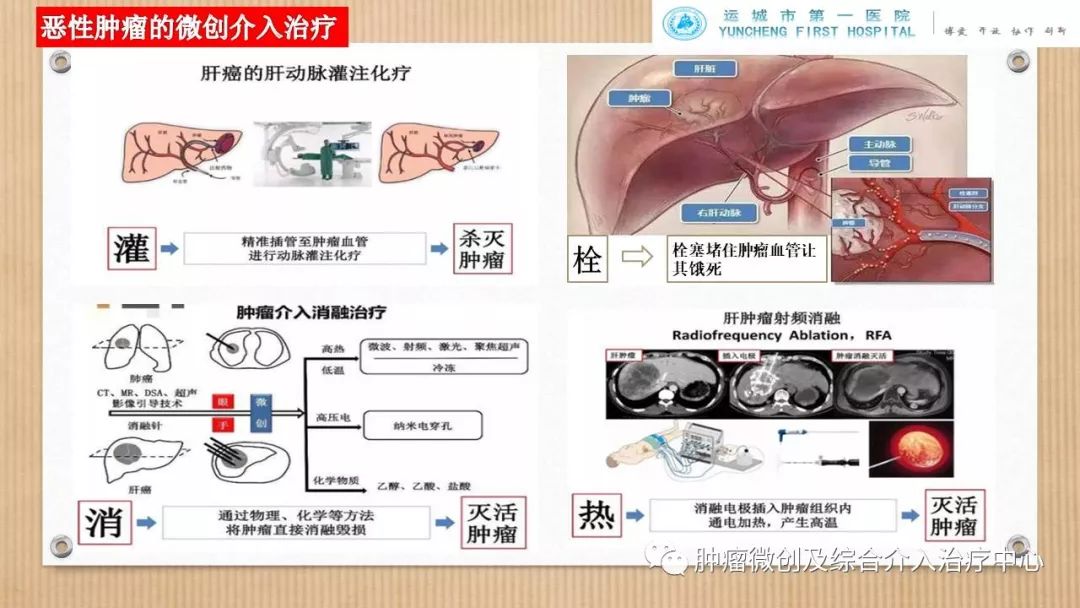 脾动脉栓塞术,脾栓塞手术的适应症