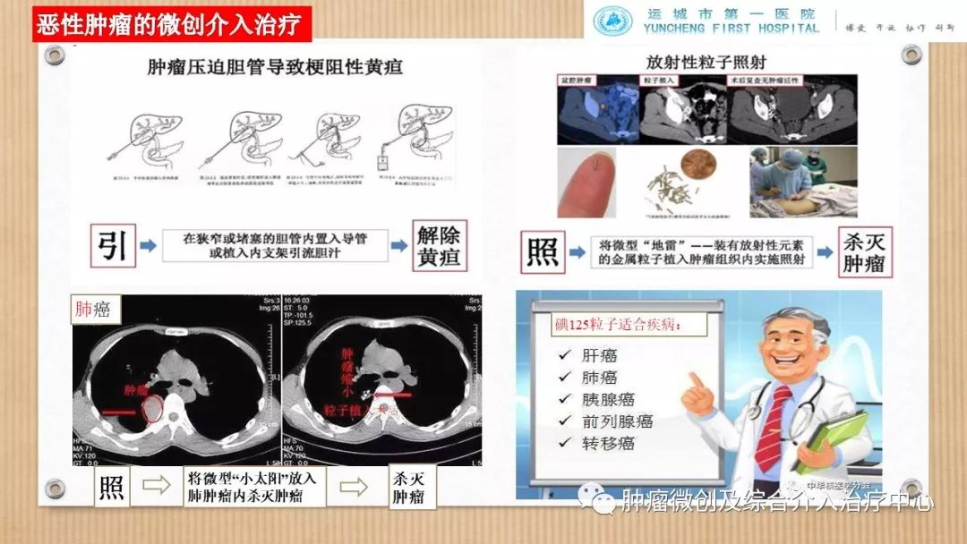 脾动脉栓塞术,脾栓塞手术的适应症