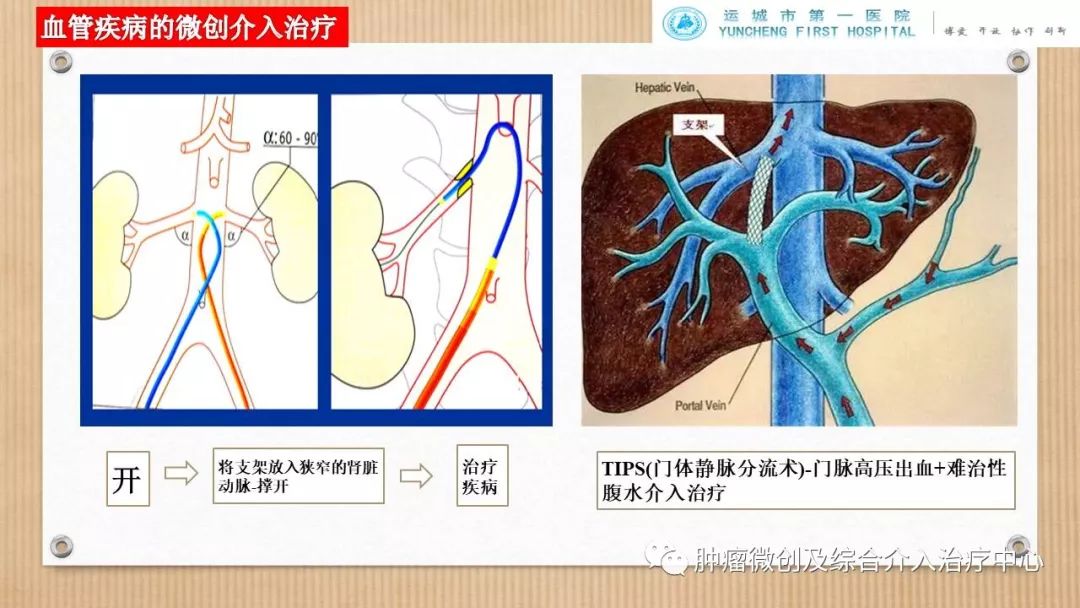 脾动脉栓塞术,脾栓塞手术的适应症