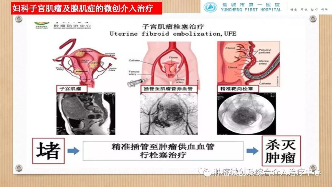 脾动脉栓塞术,脾栓塞手术的适应症