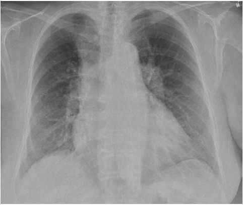 心肌梗死术后出现心衰的临床表现,心梗合并心衰的护理疑难病例讨论