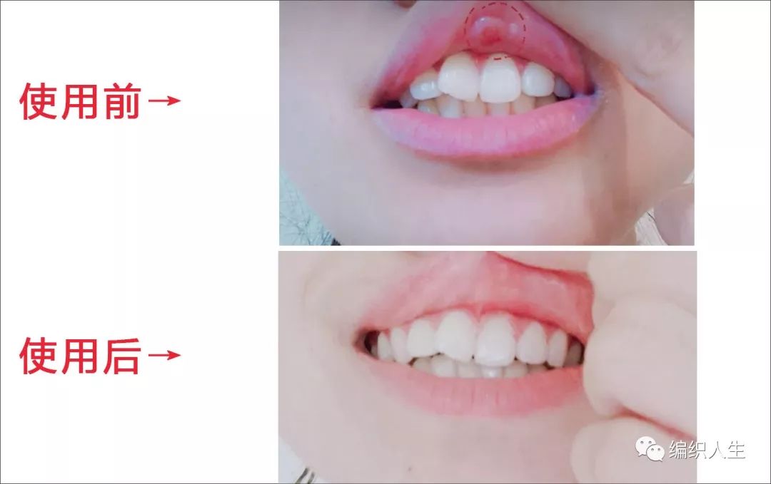 复发性口腔溃疡的特效药,治疗口腔溃疡一个药片就能搞定