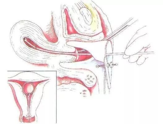 与男友共度这一夜后，24岁女孩差点……（附避孕科普）