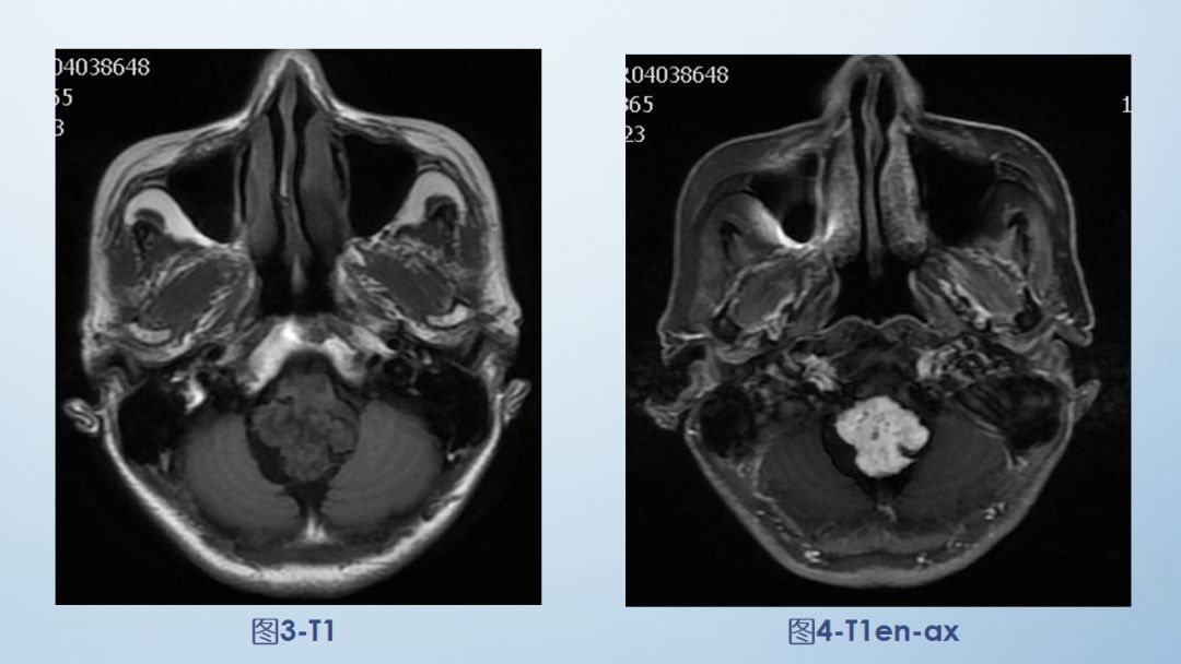 影像病例学习（3）：后颅窝实性占位病变