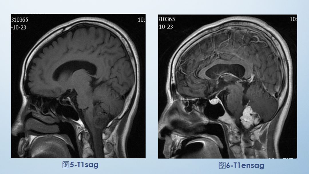影像病例学习（3）：后颅窝实性占位病变