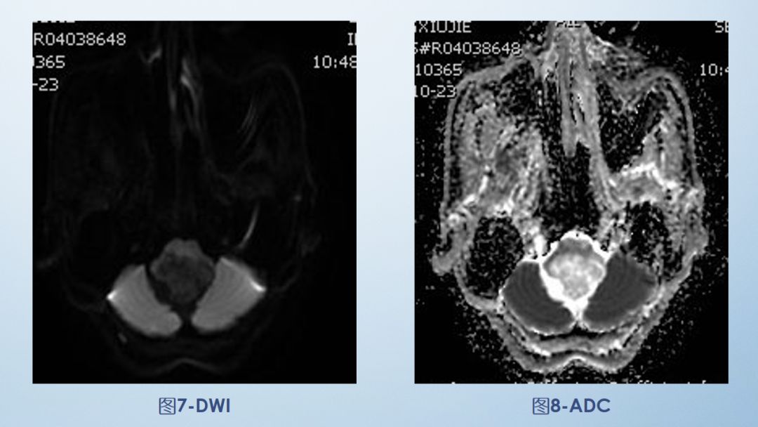 影像病例学习(3):后颅窝实性占位病变