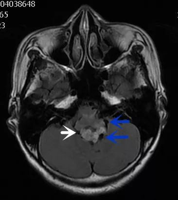 影像病例学习(3):后颅窝实性占位病变