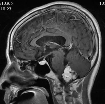 影像病例学习(3):后颅窝实性占位病变