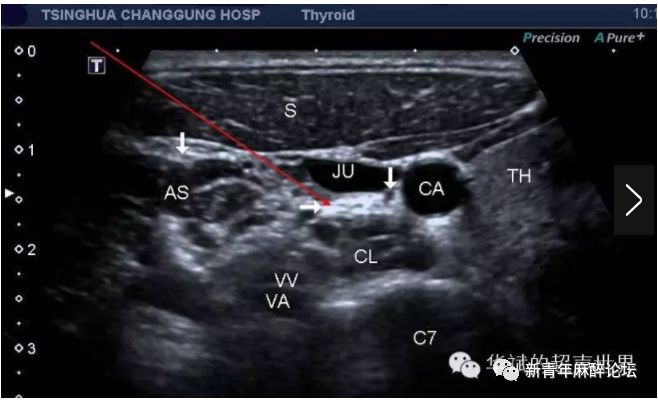 落枕了怎么办最快最有效方法,落枕了怎么办按什么穴位