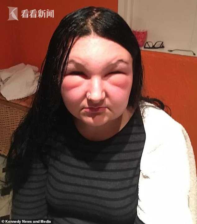 18岁女子染发剂过敏脸肿大一倍像“怪物”眼睛两天睁不开