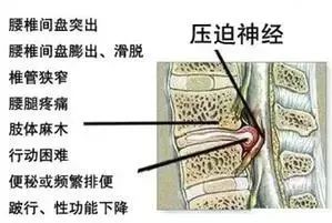 久坐相当“慢性自杀”！德国骨科专家打造的“撑腰”神器，坐9小时腰也不痛，20年颈脊椎病都好了