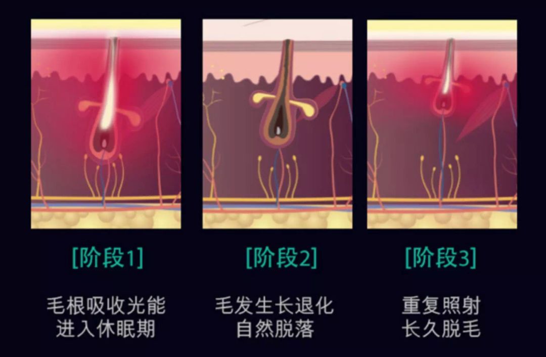 脱毛没那么复杂来这里三步搞定,这才是夏天脱毛的正确打开方式