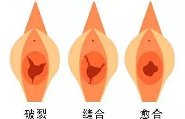 「女科荟」大部分人都错了——处女膜其实不是膜!