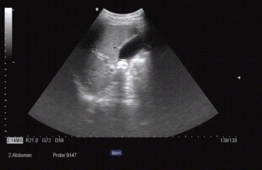 胆囊超声需要空腹吗,胆囊超声检查多少钱