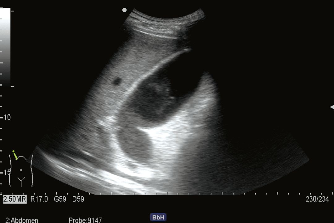 胆囊超声需要空腹吗,胆囊超声检查多少钱